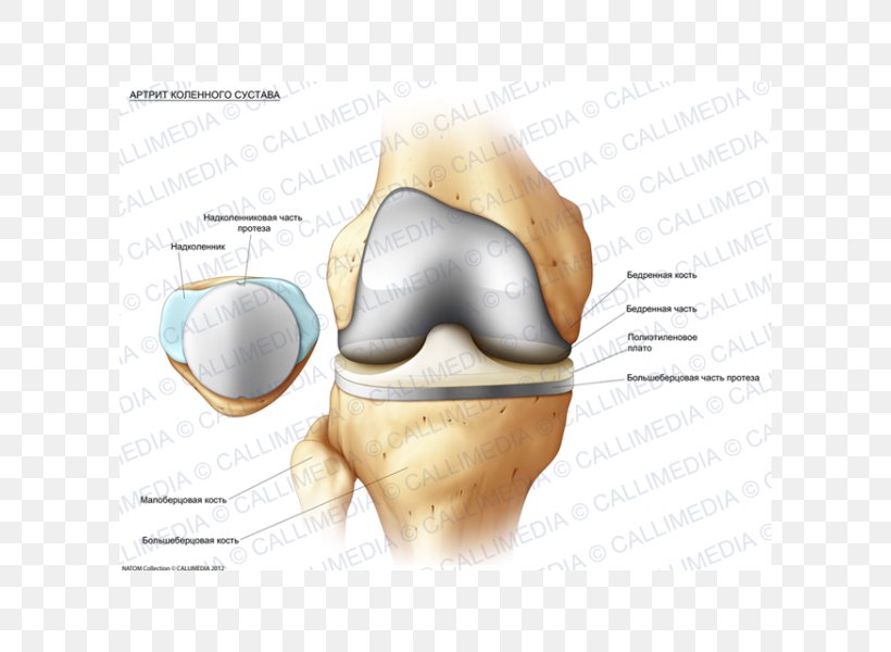 Knee Osteoarthritis Rheumatology Synovial Fluid Prosthesis, PNG, 600x600px, Watercolor, Cartoon, Flower, Frame, Heart Download Free