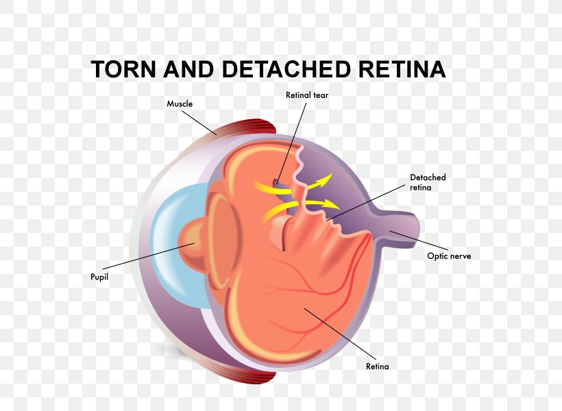 Retinal Detachment Vitreous Body Tears Eye, PNG, 800x600px, Watercolor, Cartoon, Flower, Frame, Heart Download Free