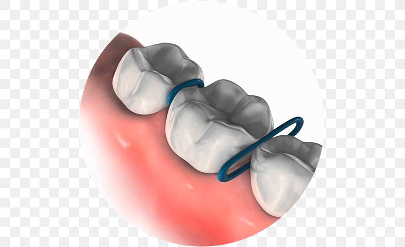Orthodontics Dental Braces Orthodontic Spacer Orthodontic Technology Rubber Bands, PNG, 500x500px, Orthodontics, Clear Aligners, Crossbite, Dental Braces, Dental Water Jets Download Free
