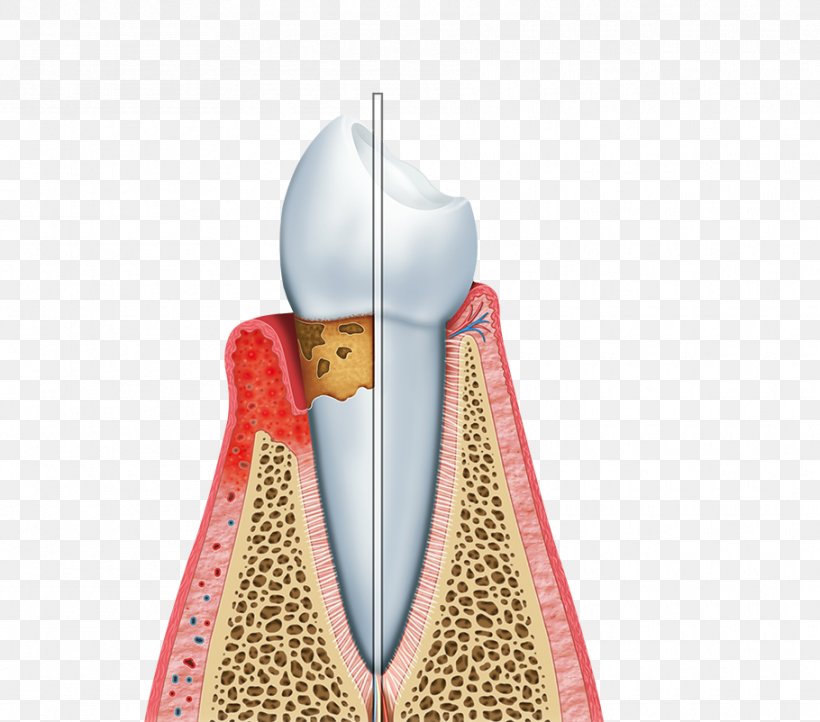 List Of Periodontal Diseases Periodontology Bleeding On Probing, PNG, 910x802px, Periodontal Disease, Bleeding On Probing, Dentistry, Disease, Gums Download Free