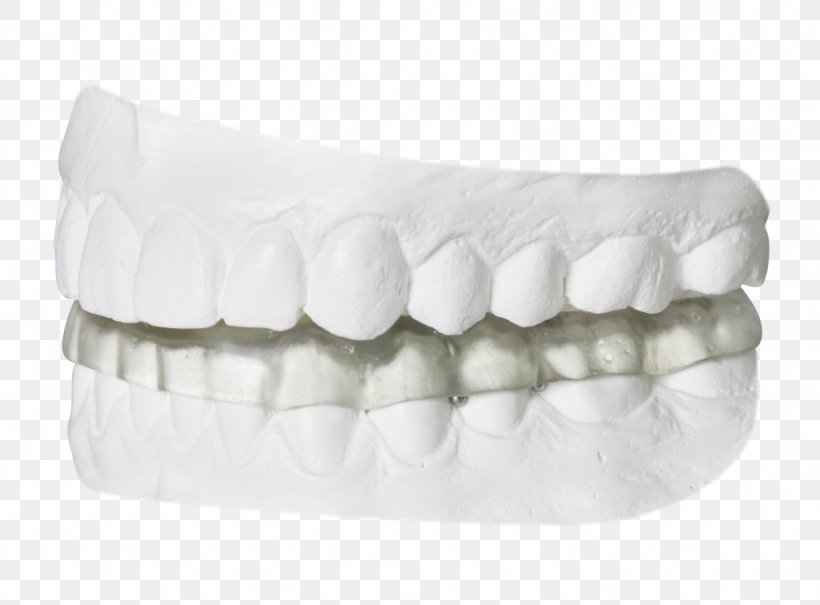 Temporomandibular Joint Dysfunction Splint Dentist Orthodontics, PNG, 1024x756px, Temporomandibular Joint Dysfunction, Bruxism, Dental Laboratory, Dentist, Dentistry Download Free