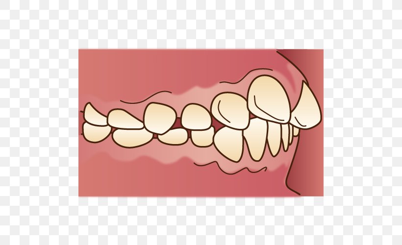 歯科 Malocclusion Dental Braces Dentition Dentist, PNG, 500x500px, Watercolor, Cartoon, Flower, Frame, Heart Download Free