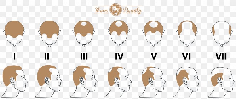 Pattern Hair Loss Hair Transplantation Hamilton–Norwood Scale, PNG, 1500x628px, Hair Loss, Beard, Body Hair, Botak, Ear Download Free