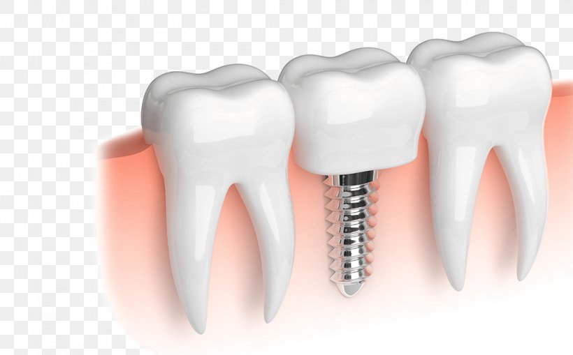 Dental Implant Dentistry Dental Restoration Dentures, PNG, 1042x648px, Watercolor, Cartoon, Flower, Frame, Heart Download Free