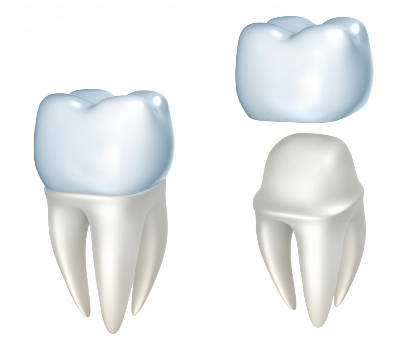 Crown Dentistry Dental Restoration Bridge, PNG, 1233x1047px, Watercolor, Cartoon, Flower, Frame, Heart Download Free