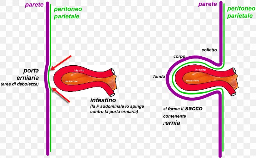 Inguinal Hernia Abdominal Hernia Umbilical Hernia Schmorl's Nodes, PNG, 1000x620px, Watercolor, Cartoon, Flower, Frame, Heart Download Free