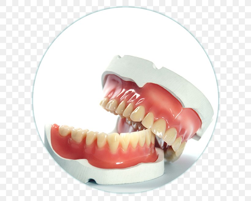 Dentures Prosthesis Dentistry Tooth, PNG, 656x656px, Dentures, Cosmetic Dentistry, Crown, Dental Implant, Dental Prosthesis Download Free