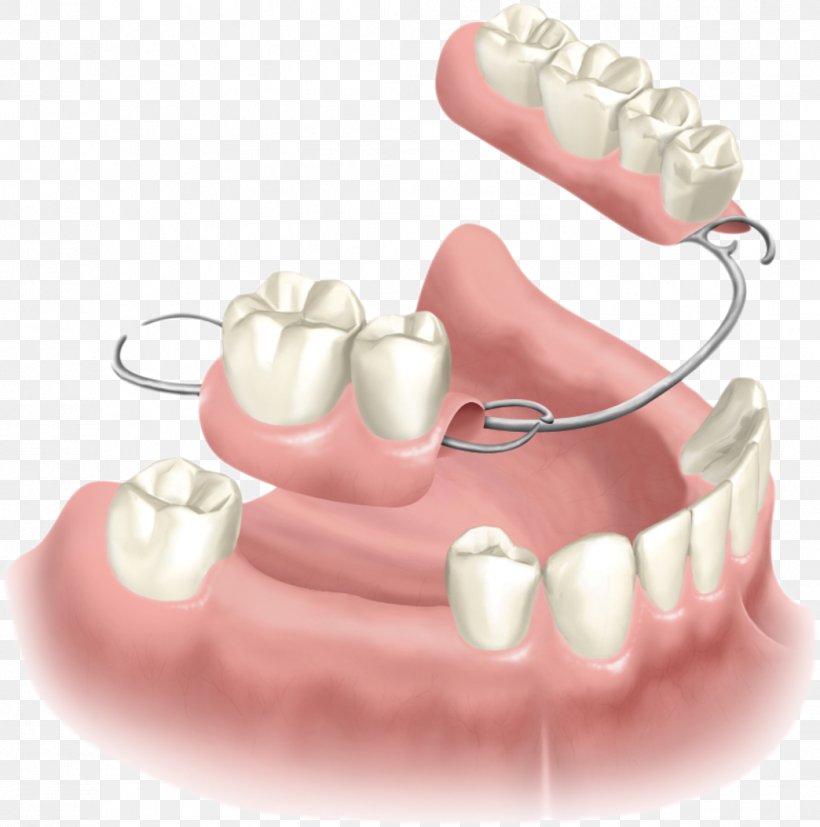 Removable Partial Denture Dentures Dental Implant Dentistry, PNG, 1044x1053px, Removable Partial Denture, Abutment, Bridge, Chin, Cosmetic Dentistry Download Free