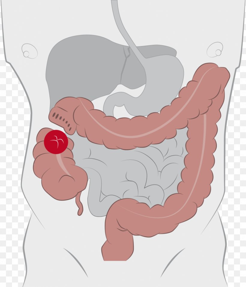 Colostomy Ileostomy Ostomy Pouching System Stoma Ileo-anal Pouch, PNG, 879x1024px, Watercolor, Cartoon, Flower, Frame, Heart Download Free