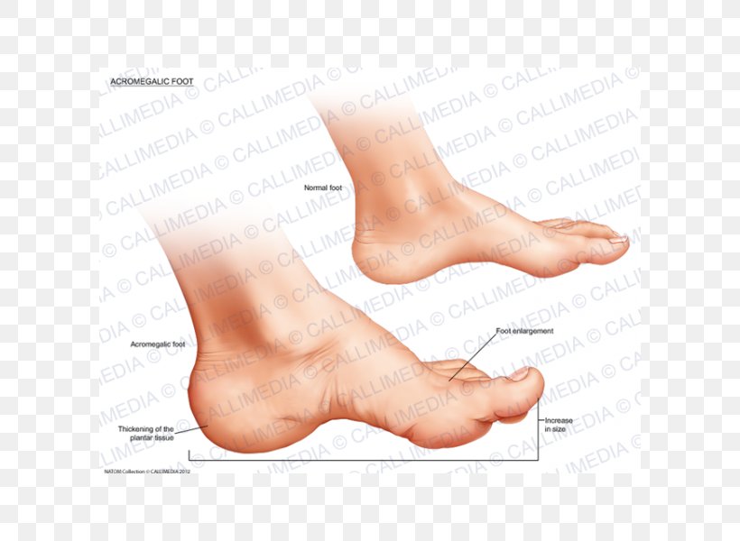 Thumb Acromegaly Foot Ankle Endocrinology, PNG, 600x600px, Watercolor, Cartoon, Flower, Frame, Heart Download Free
