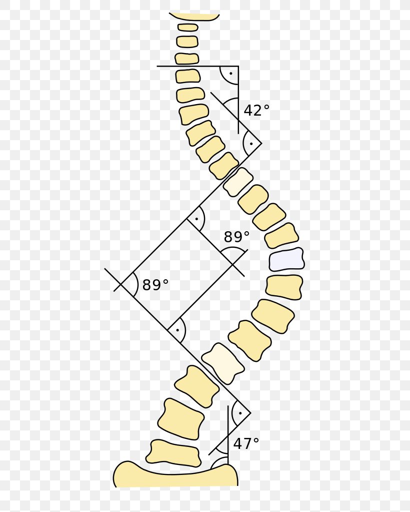 Cobb Angle Three-Dimensional Treatment For Scoliosis: A Physiotherapeutic Method For Deformities Of The Spine Kyphosis Disease, PNG, 472x1023px, Cobb Angle, Area, Degree, Diagram, Disease Download Free
