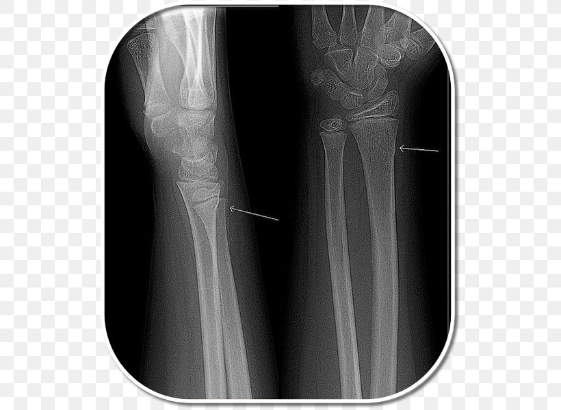 X-ray Shoulder Greenstick Fracture Radiography, PNG, 527x599px, Xray, Arm, Black And White, Bone, Greenstick Fracture Download Free