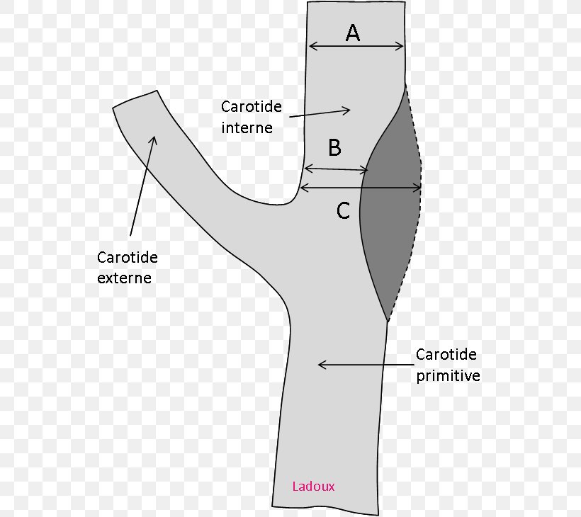 Carotid Artery Stenosis Common Carotid Artery Internal Carotid Artery Doppler Ultrasonography, PNG, 575x730px, Watercolor, Cartoon, Flower, Frame, Heart Download Free