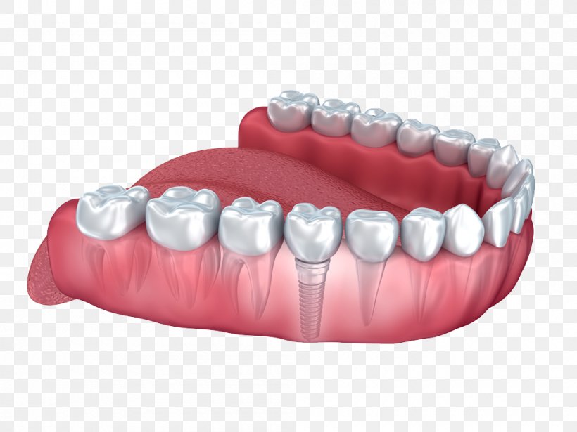 Dental Implant Human Tooth Dentistry, PNG, 1000x750px, Dental Implant, Dental Extraction, Dental Surgery, Dentin, Dentistry Download Free