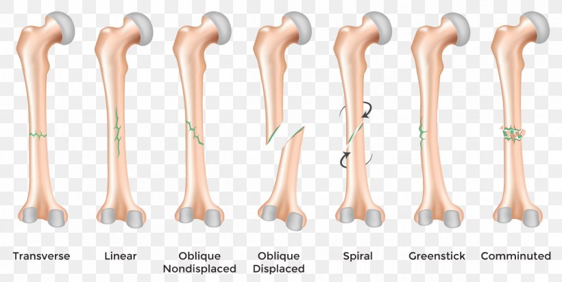 Bone Fracture Bone Healing Femoral Fracture Injury, PNG, 1200x604px, Bone Fracture, Ankle Fracture, Arm, Bone, Bone Disease Download Free