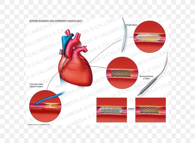 Angioplasty Heart Coronary Artery Bypass Surgery Stenting, PNG, 600x600px, Watercolor, Cartoon, Flower, Frame, Heart Download Free