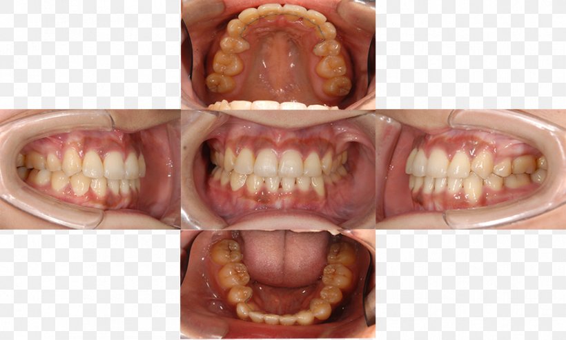 Tooth Periodontal Disease Dentistry Medical Specialist 日本歯周病学会認定歯周病専門医, PNG, 901x542px, Tooth, Dental Calculus, Dental Implant, Dentistry, Dentition Download Free