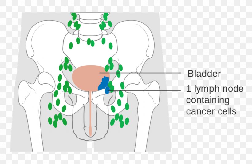 Bladder Cancer Urinary Bladder Cancer Staging Carcinoma, PNG, 975x634px, Watercolor, Cartoon, Flower, Frame, Heart Download Free
