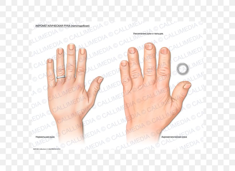 Acromegaly Nail Hand Endocrinology Thumb, PNG, 600x600px, Acromegaly, Arm, Digit, Disease, Endocrinology Download Free