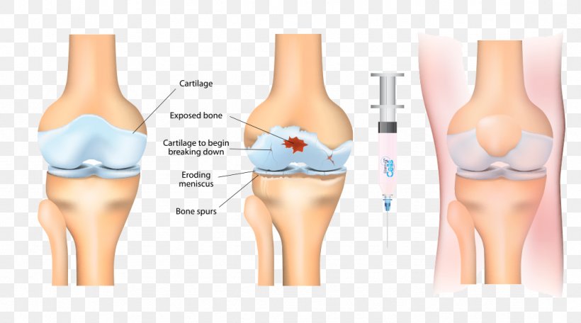 Stem-cell Therapy Osteoarthritis Platelet-rich Plasma Stem Cell Knee Arthritis, PNG, 1077x600px, Watercolor, Cartoon, Flower, Frame, Heart Download Free