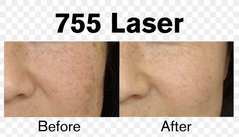 Eyebrow Laser Hair Removal Skin Arm, PNG, 1024x589px, Eyebrow, Alexandrite, Arm, Cheek, Chin Download Free