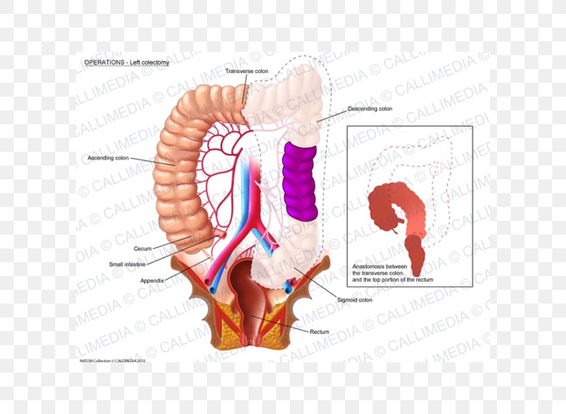 Colectomy Colorectal Cancer Rectum Lymph Node Surgery, PNG, 600x600px, Watercolor, Cartoon, Flower, Frame, Heart Download Free