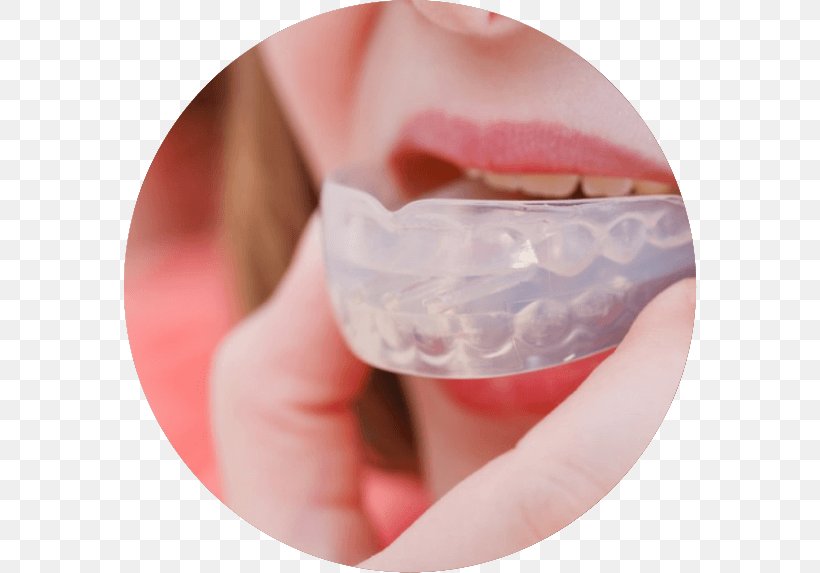 Mouthguard Bruxism Dentistry, PNG, 574x573px, Mouthguard, Bruxism, Cheek, Chin, Close Up Download Free