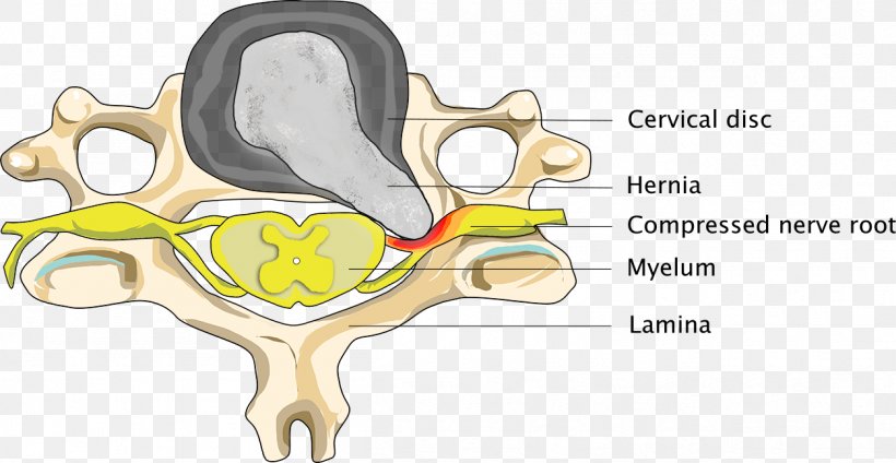 Elastic Therapeutic Tape Spinal Disc Herniation Neck Osteoarthritis Intervertebral Disc, PNG, 1254x649px, Watercolor, Cartoon, Flower, Frame, Heart Download Free