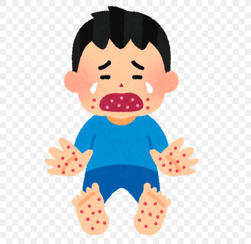 Hand, Foot, And Mouth Disease Infection Adenoviral Keratoconjunctivitis Blister, PNG, 740x800px, Hand Foot And Mouth Disease, Adenoviral Keratoconjunctivitis, Baby Toys, Blister, Boy Download Free