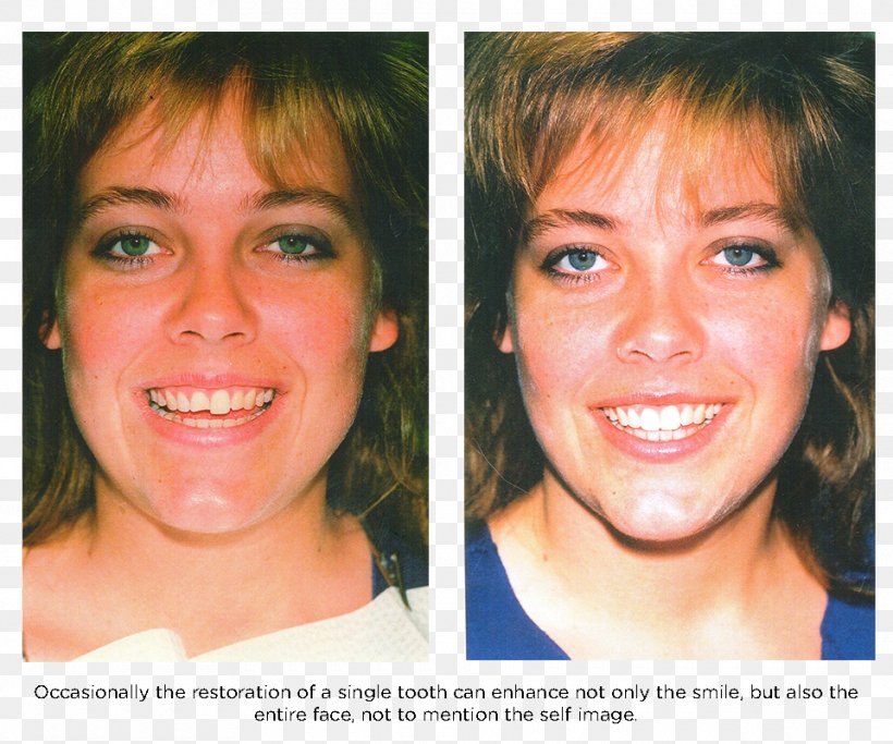 Veneer Smile Human Tooth Dentist, PNG, 960x800px, Veneer, Bridge, Cheek, Chin, Dentist Download Free