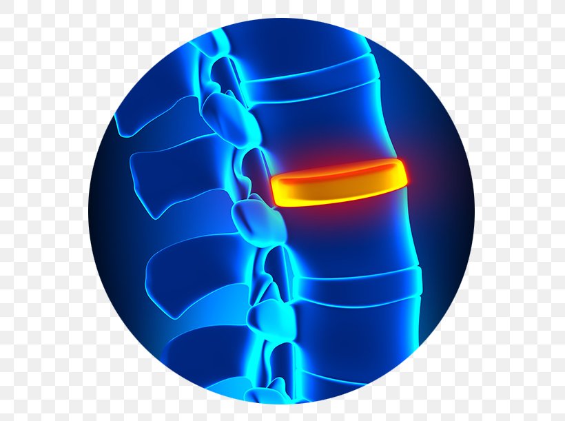 Spinal Disc Herniation Degenerative Disc Disease Vertebral Column Orthopedic Surgery, PNG, 586x611px, Spinal Disc Herniation, Ache, Chiropractic, Degenerative Disc Disease, Electric Blue Download Free
