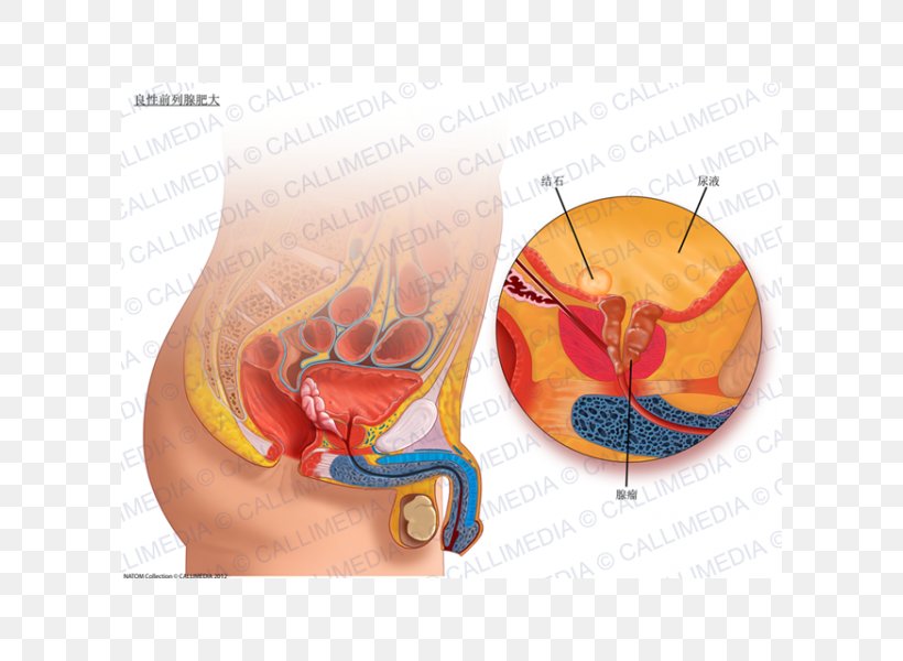 Ultrasonography Benign Prostatic Hyperplasia Prostate TERATECH Corporation, PNG, 600x600px, Watercolor, Cartoon, Flower, Frame, Heart Download Free