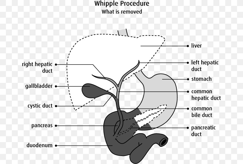 Pancreaticoduodenectomy Bile Duct Surgery Biliary Tract Pancreatic Cancer, PNG, 671x554px, Watercolor, Cartoon, Flower, Frame, Heart Download Free