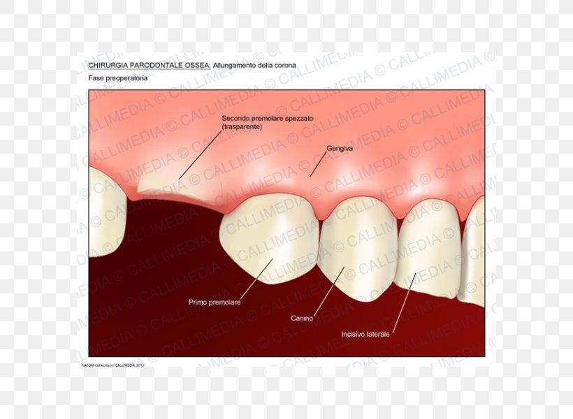 Surgery Crown Lengthening Periodontal Disease Periodontology Medicine, PNG, 600x600px, Surgery, Bone, Bone Grafting, Crown, Crown Lengthening Download Free