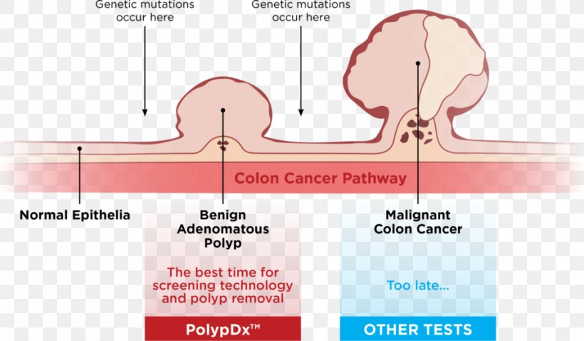 Colorectal Polyp Colorectal Cancer Adenoma Cancer Screening, PNG, 950x556px, Watercolor, Cartoon, Flower, Frame, Heart Download Free
