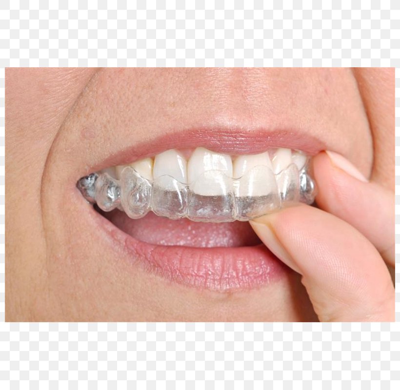 Clear Aligners Cosmetic Dentistry Orthodontics Dental Braces, PNG, 800x800px, Clear Aligners, Close Up, Cosmetic Dentistry, Dental Braces, Dental Degree Download Free