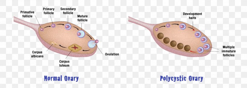 Polycystic Ovary Syndrome Diet Food Eating, PNG, 2636x948px, Watercolor, Cartoon, Flower, Frame, Heart Download Free