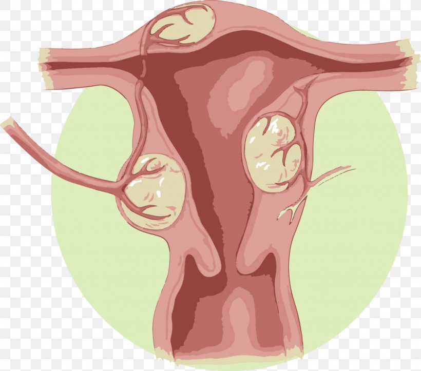 Uterine Fibroid Uterine Artery Embolization Uterus Benign Tumor, PNG, 1024x903px, Watercolor, Cartoon, Flower, Frame, Heart Download Free