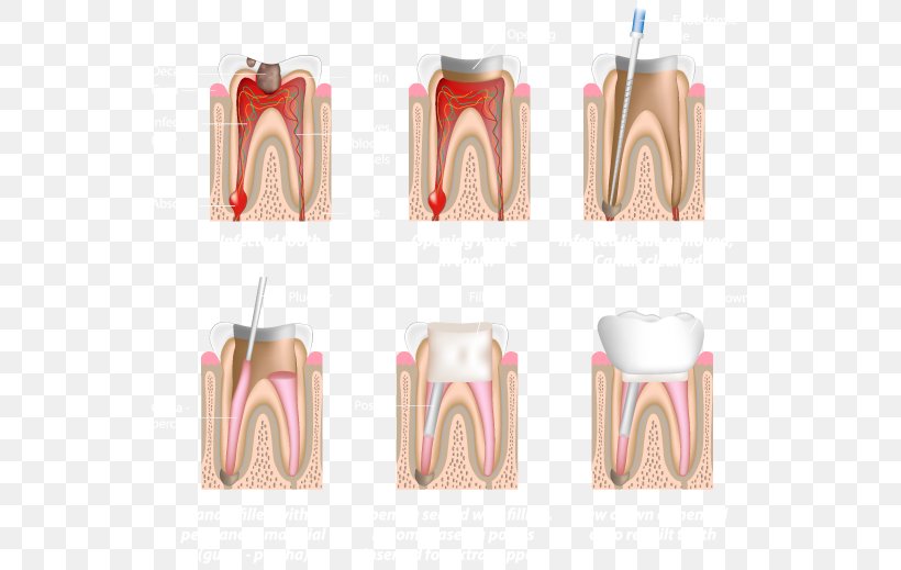 Endodontic Therapy Root Canal Endodontics Dentistry, PNG, 549x519px, Endodontic Therapy, Ache, Dental Surgery, Dentist, Dentistry Download Free