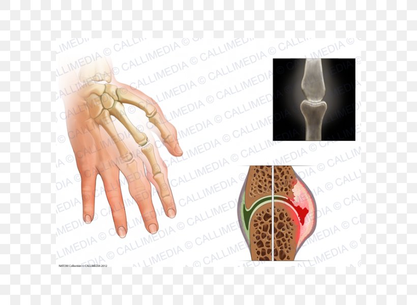 Rheumatoid Arthritis Chronic Childhood Arthritis Disease Joint, PNG, 600x600px, Rheumatoid Arthritis, Arthritis, Child, Chronic Childhood Arthritis, Disease Download Free