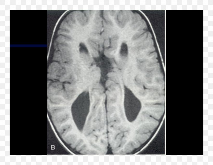 Computed Tomography Lääketieteellinen Röntgenkuvaus X-ray Brain Radiography, PNG, 1584x1224px, Watercolor, Cartoon, Flower, Frame, Heart Download Free