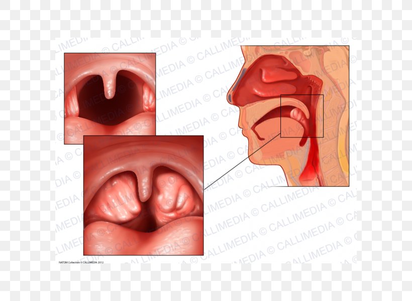 Tonsillitis Anatomy Adenoid Infection, PNG, 600x600px, Watercolor, Cartoon, Flower, Frame, Heart Download Free