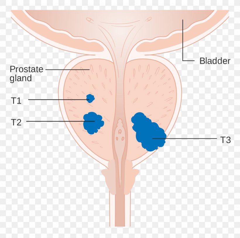 Prostate Cancer Staging Carcinoma In Situ, PNG, 1024x1018px, Watercolor, Cartoon, Flower, Frame, Heart Download Free