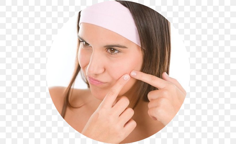 Acne Pimple Scar Skin Care Tretinoin, PNG, 500x500px, Acne, Beauty, Cause, Cheek, Chin Download Free