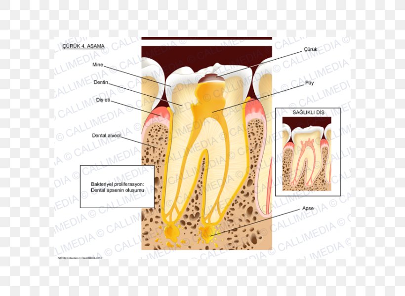 Dental Abscess Tooth Brushing Dentist, PNG, 600x600px, Watercolor, Cartoon, Flower, Frame, Heart Download Free