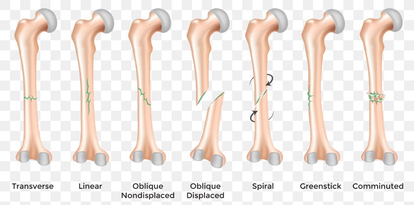 Bone Fracture Diagram Femoral Fracture Femur, PNG, 810x407px, Bone Fracture, Arm, Bone, Bone Healing, Diagram Download Free