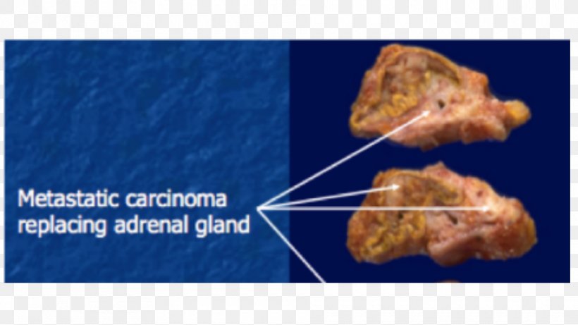 Adrenal Gland Cell Parathyroid Gland Endocrine Pathology, PNG, 960x540px, Adrenal Gland, Adipose Tissue, Animal Source Foods, Carcinoma, Cell Download Free