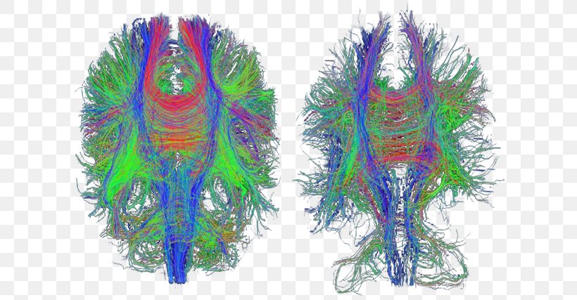 Traumatic Brain Injury Diffusion MRI Alzheimer's Disease Medical Imaging, PNG, 623x427px, Watercolor, Cartoon, Flower, Frame, Heart Download Free