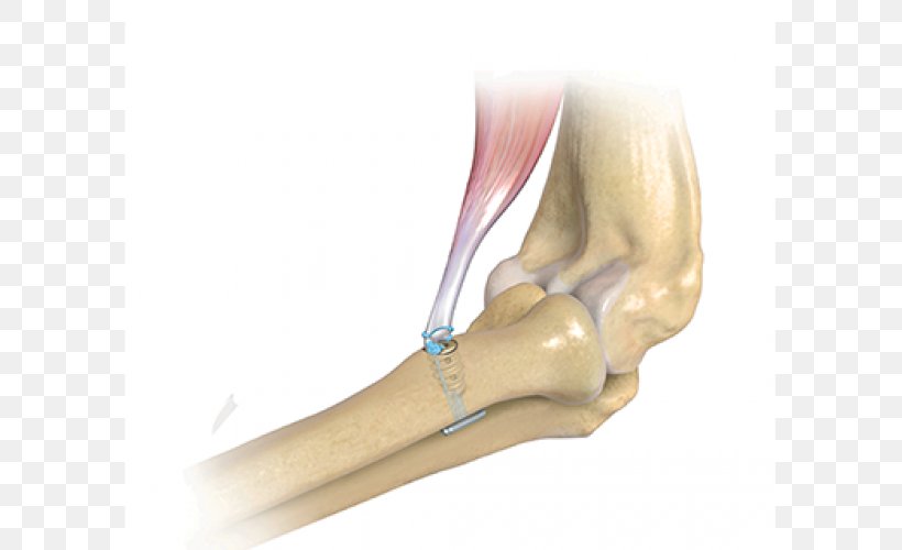 Biceps Tendon Distal Bizepssehnenruptur Elbow, PNG, 800x500px, Biceps, Achilles Tendon Rupture, Arm, Bizepssehnenruptur, Bone Download Free