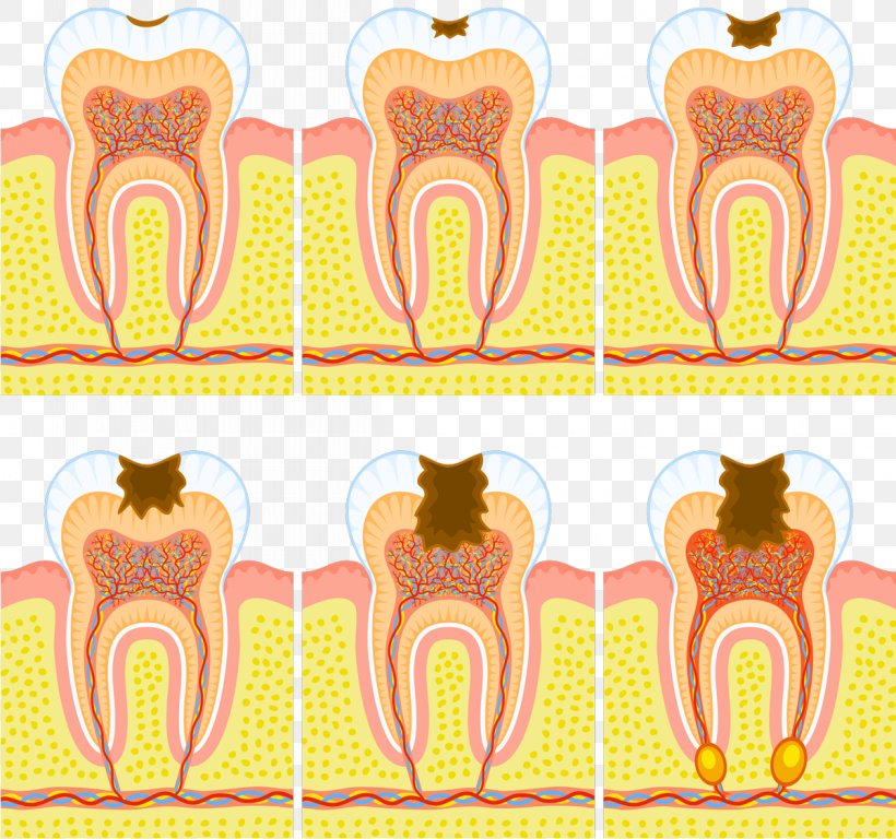 Tooth Decay Dentistry Pulp Human Tooth Dental Abscess, PNG, 1200x1125px, Watercolor, Cartoon, Flower, Frame, Heart Download Free